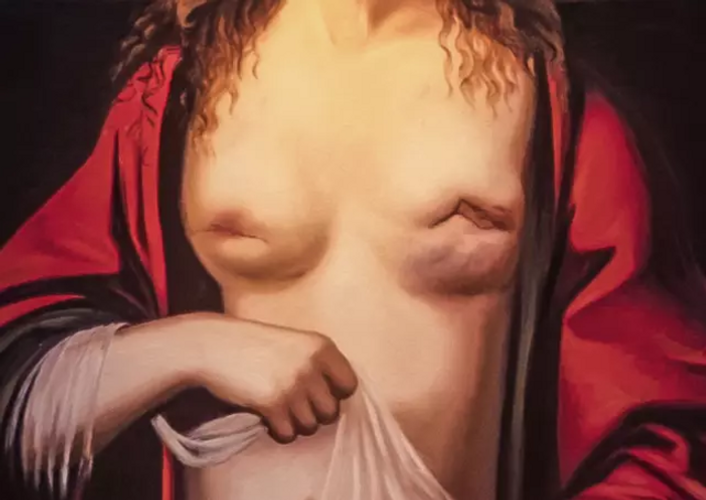 Breast Cancer